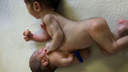Heartbreaking Decision To Remove Parasitic Twin From Brother's Stomach So One Child Can Survive