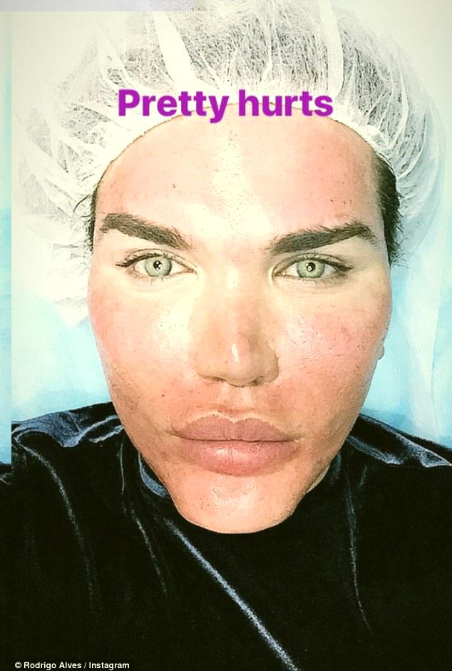 'My Face is Burning' - Human Ken Doll who's had over 60 plastic surgeries, shows off peeling face