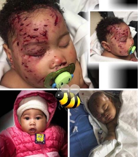 4 Month Old Baby Attacked By Raccoon While She Was Asleep, Gets 65 Stitches To Her Face.