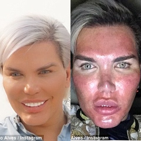 "My Face is Burning" - Human Ken Doll who's had over 60 plastic surgeries, shows off peeling face