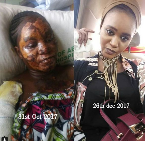 Before & After: Gas explosion survivor thanks everyone who prayed for her