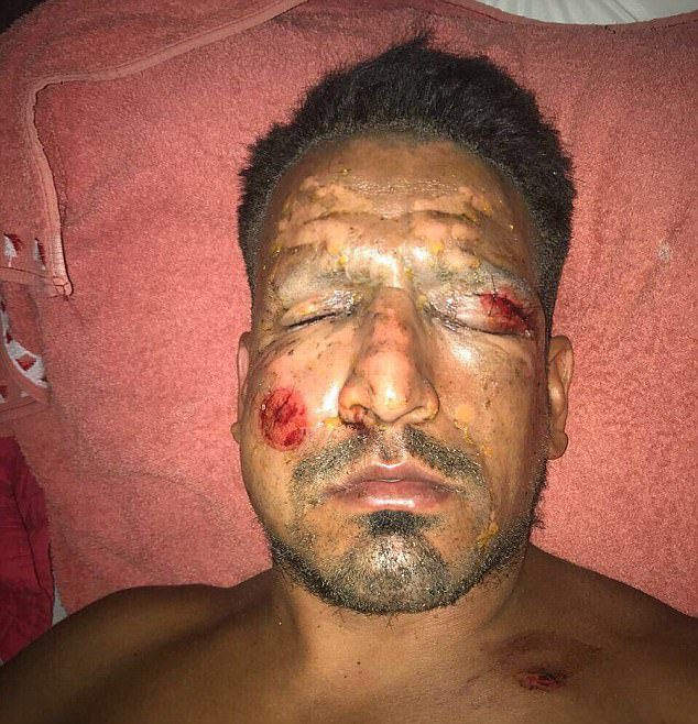 Former Argentine Footballer, Lucas Viatri Severely Wounded After A Firework Exploded In His Face (Photo)