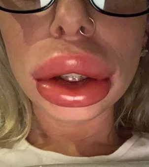 How botched lip filler procedure distorted a woman's lips (Photos)