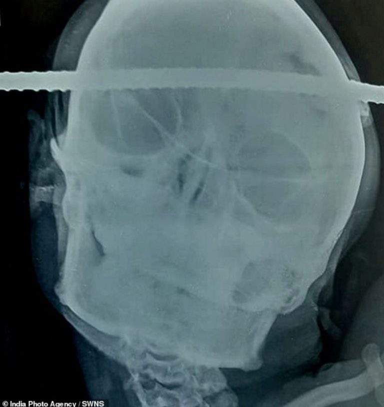 Indian man survives after being impaled in the head with a rod (Disturbing photos)