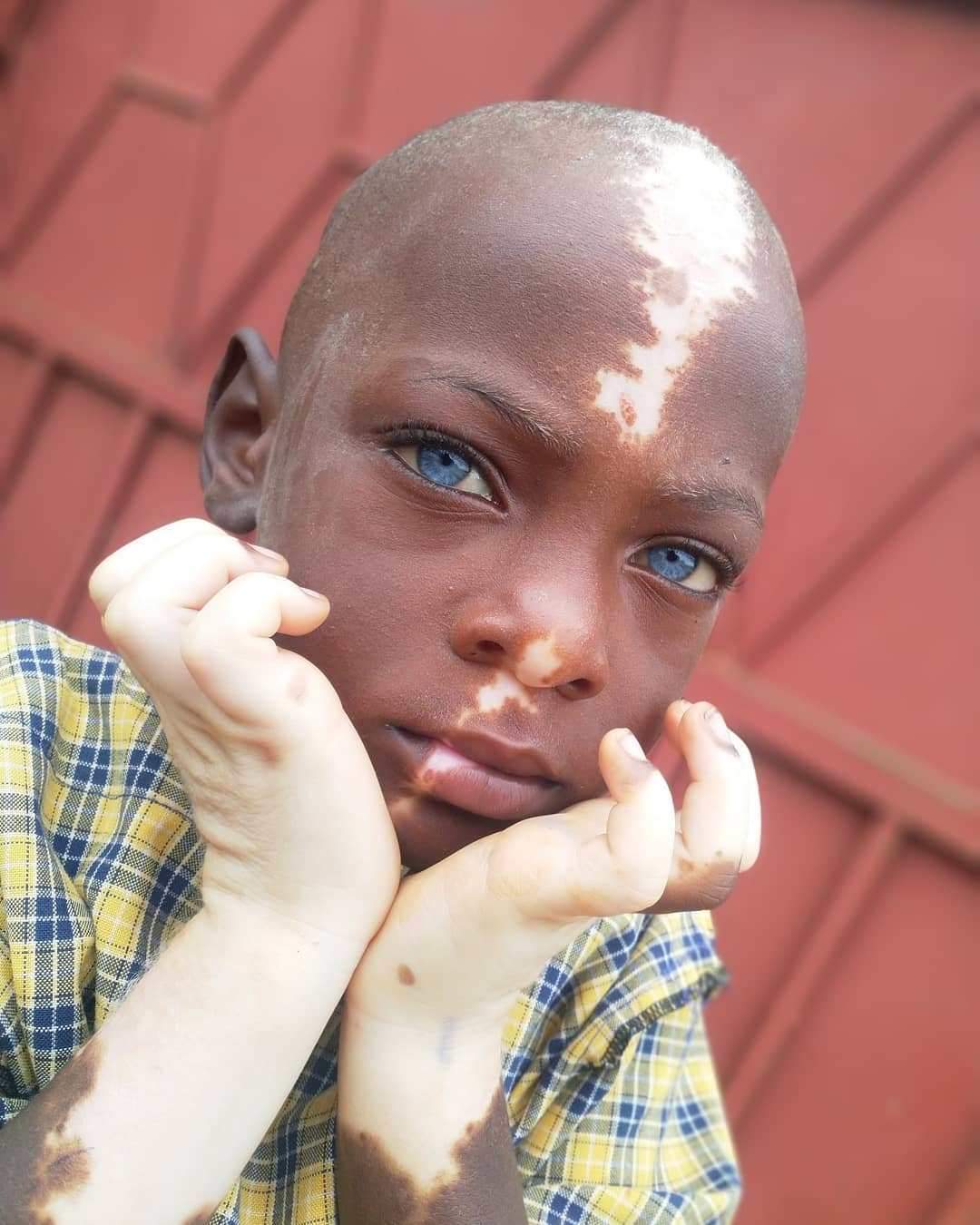 Ugandan boy becomes internet sensation because of his unique birthmarks (Photos)