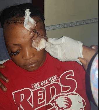 Woman who survived ghastly accident which split her head open shows off impressive transformation