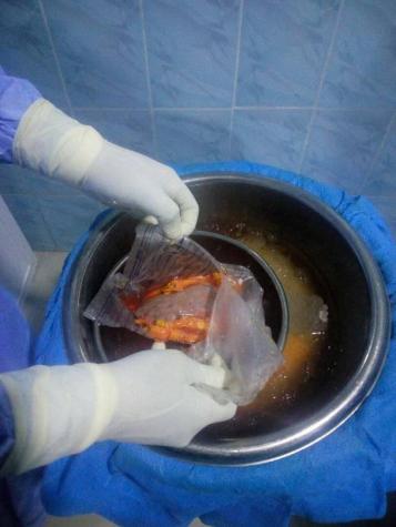 First Ever Successful Kidney Transplant In South East Takes Place At FMC Umuahia (Photos)