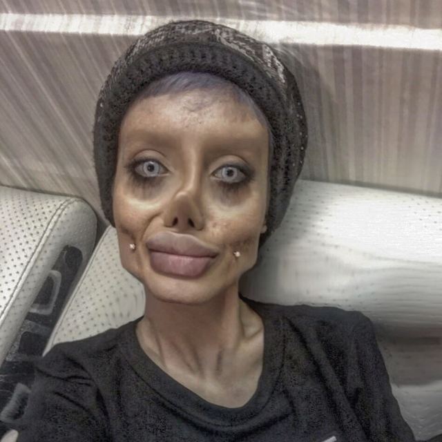 19 year old girl undergoes 50 surgeries to look like Angelina Jolie but it went horribly wrong
