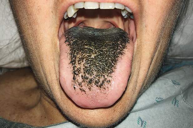 55-year-old woman gets Black Hairy Tongue after Car Crash!
