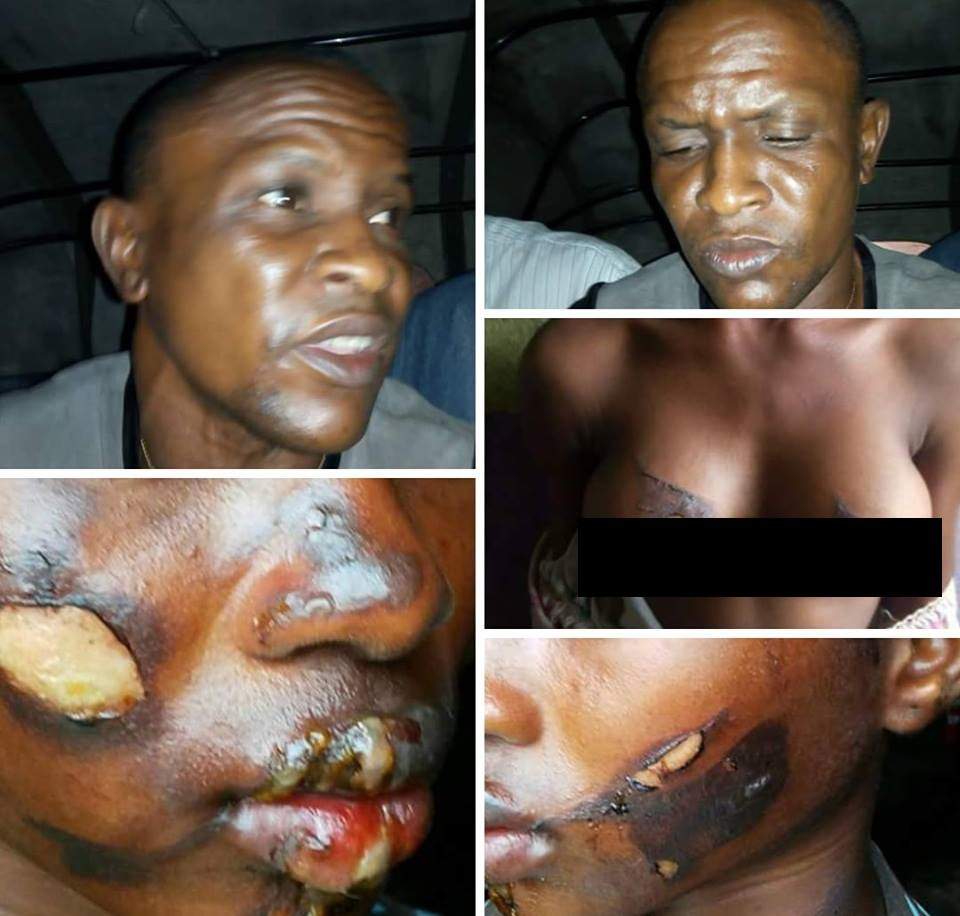 Man burns 13-year-old niece's face, breasts with hot iron over missing N3000 in Bayelsa