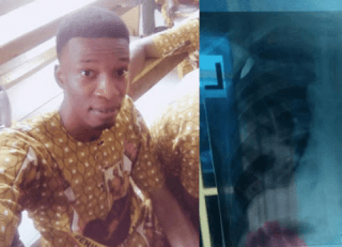 "Only fools say there is no God" - Young Nigerian guy says as he survives stray bullet that hit him while he was asleep