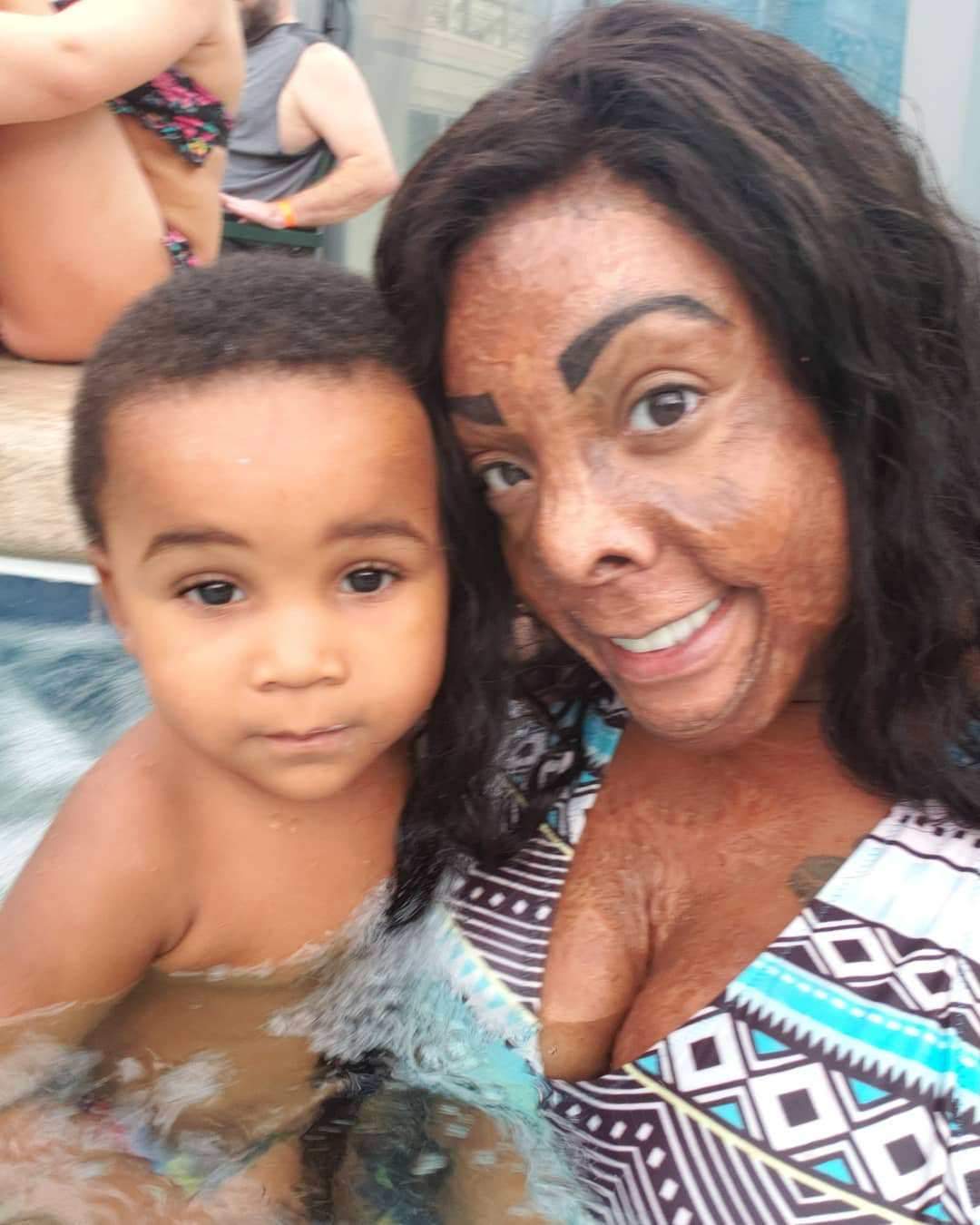 Lovely photos of burn survivor and her two kids melt hearts on social media (Photos)