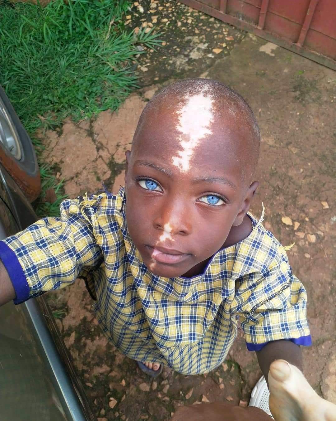 Ugandan boy becomes internet sensation because of his unique birthmarks (Photos)