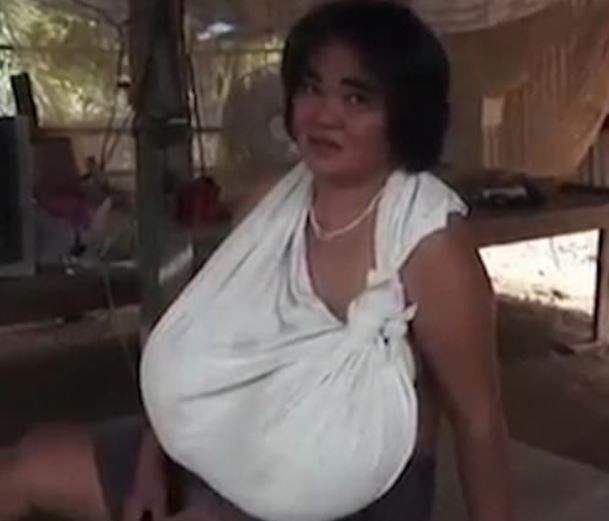 Woman unable to walk or move around because her breasts won't stop growing (Photos)