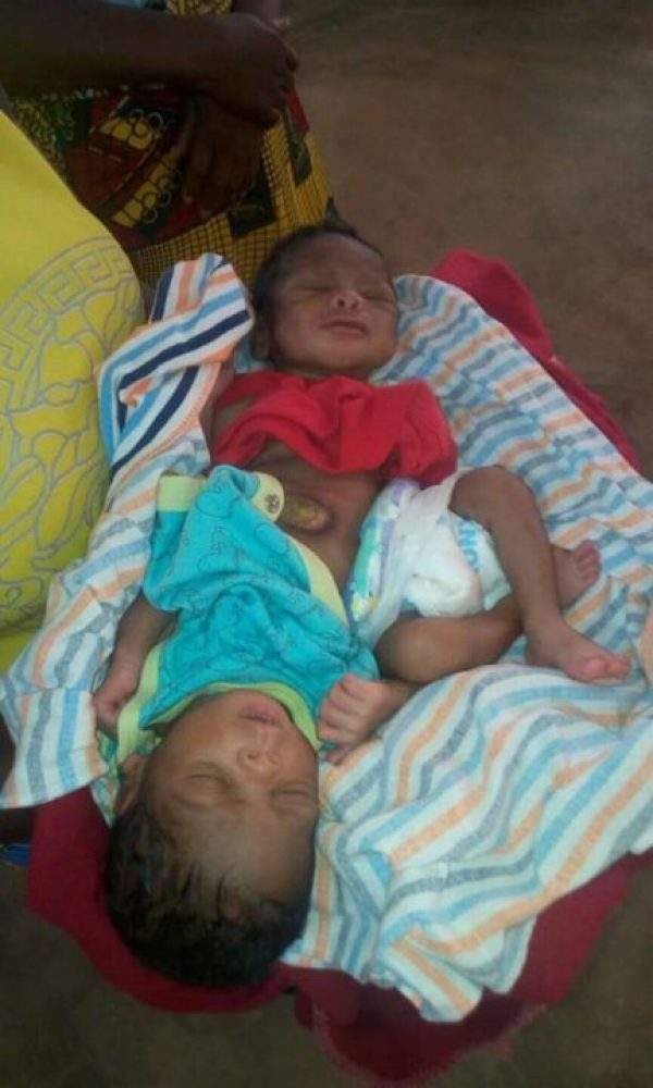 Lady delivers conjoined twins in Benue (Photos)