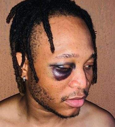 Viktoh shares new photo of his swollen eye after assault from Police