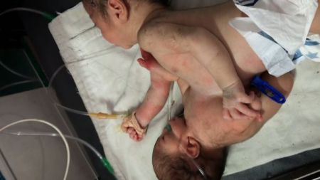 Heartbreaking Decision To Remove Parasitic Twin From Brother's Stomach So One Child Can Survive
