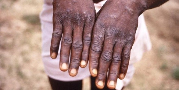 Six more cases of monkeypox confirmed