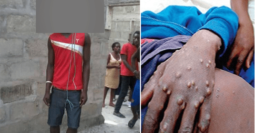 Monkeypox victim commits suicide in Bayelsa