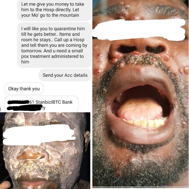 Heavily pregnant Nigerian lady and husband infected with MonkeyPox in Rivers cries out