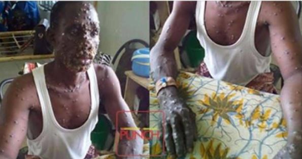 Monkeypox spreads to Akwa Ibom, Rivers state