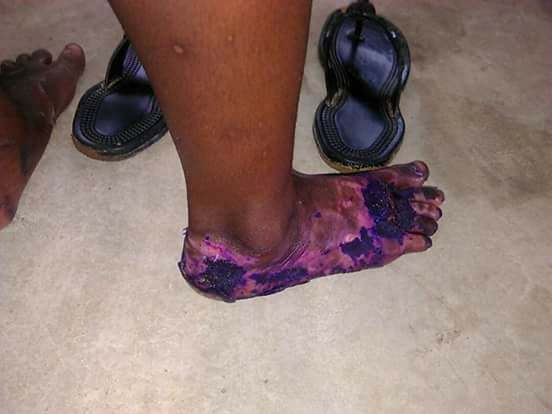 Pregnant Ghanaian Lady Dumps Her 5-Year-old Step-Daughter Inside Hot Water For Bed-wetting (Photos)