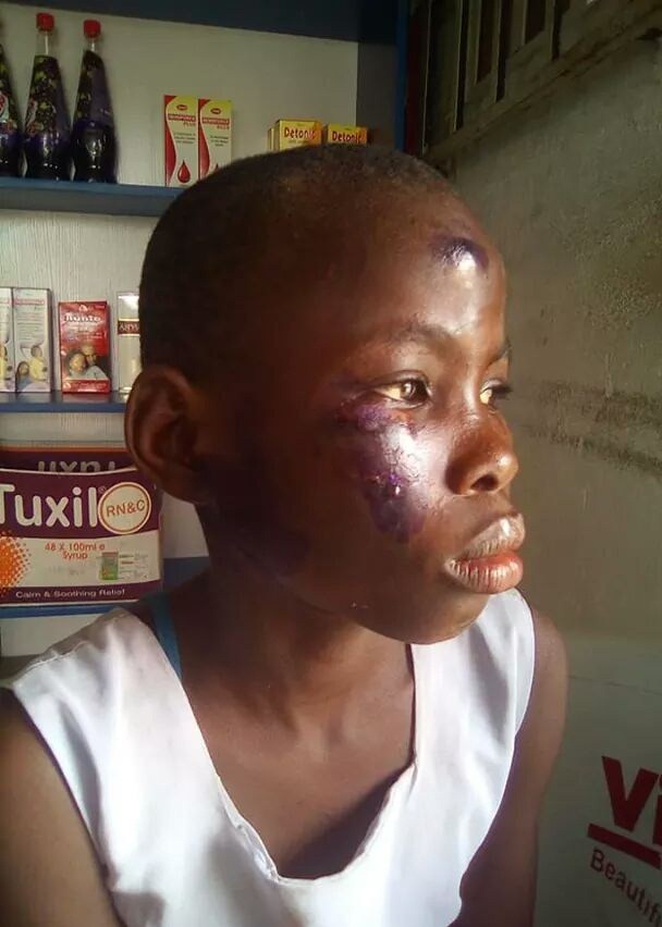 Mother Burns Her 10-Year-Old Daughter's Face With Electric Iron Over Missing N200 (Photos)