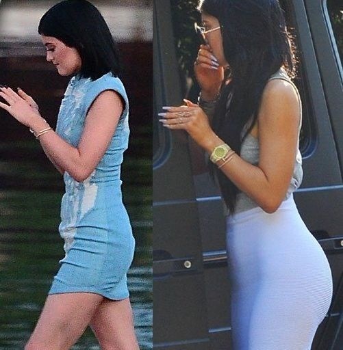 Before and After pictures - Kylie Jenner plastic surgery history