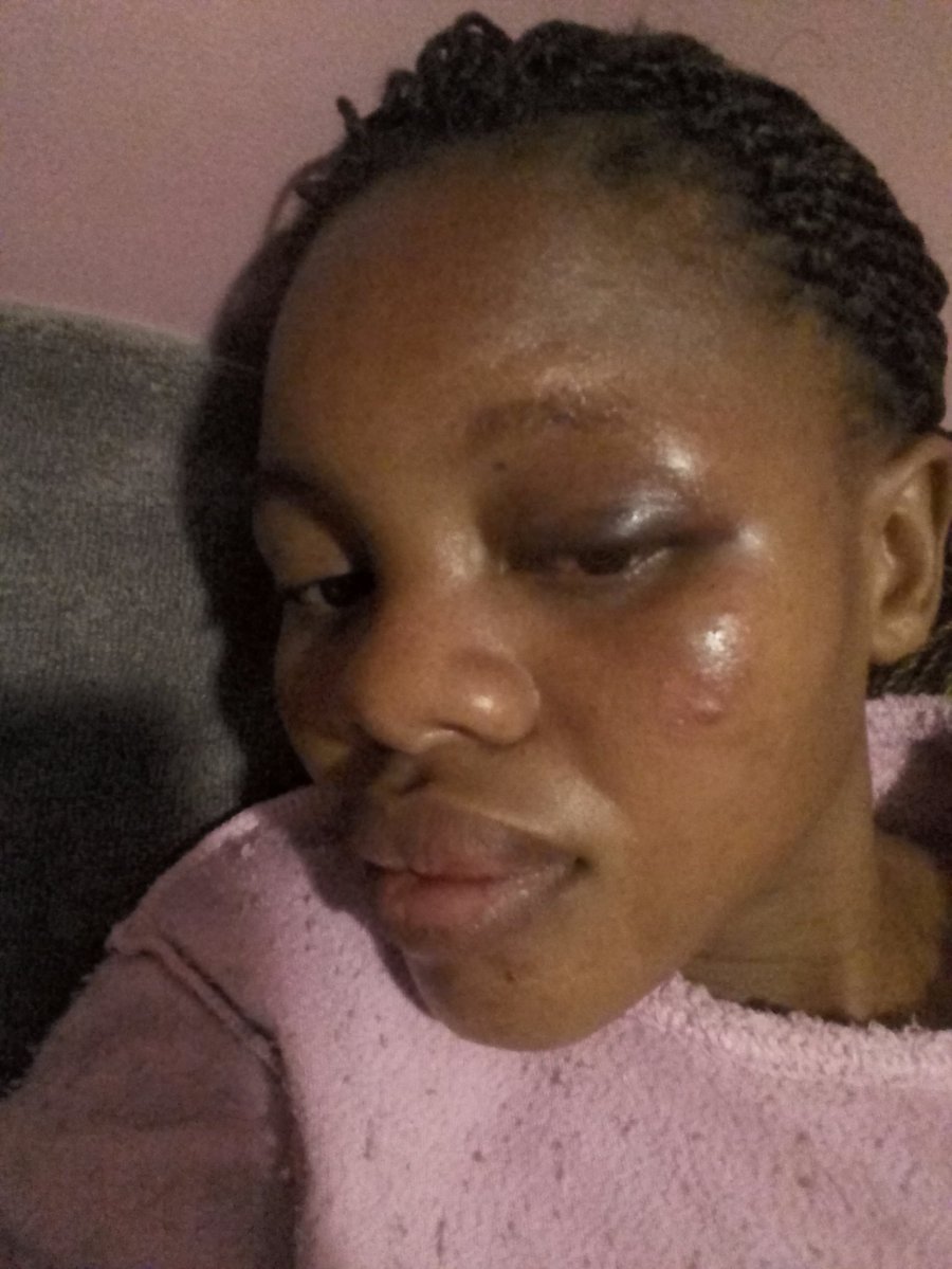 Lady cries out, after her baby daddy beat her to stupor
