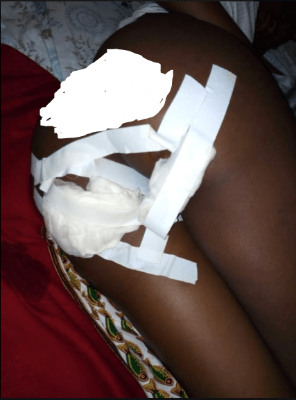 Slay Queen lands in Hospital with broken buttocks after bike accident (Photos)