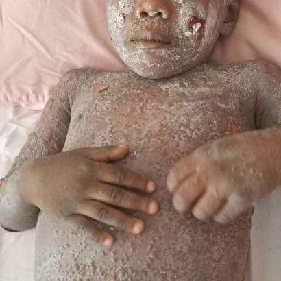 Little boy suffers critical skin reaction after taking fake anti-malaria drug