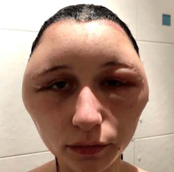 Lady's head expands after using hair dye