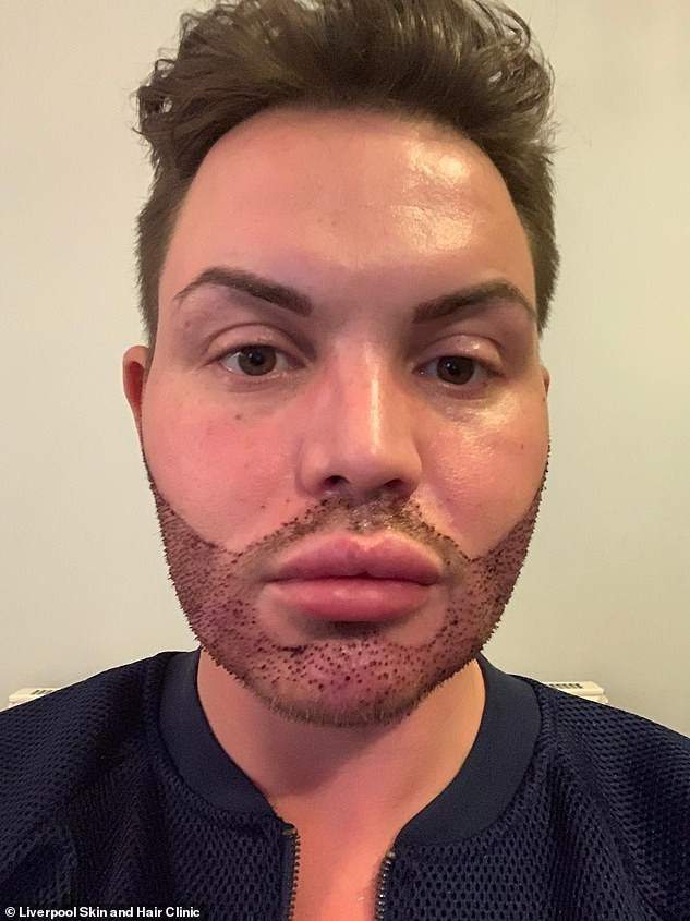 TV personality, Bobby Norris who spent £9,000 on beard transplant, shows off result (Photos)