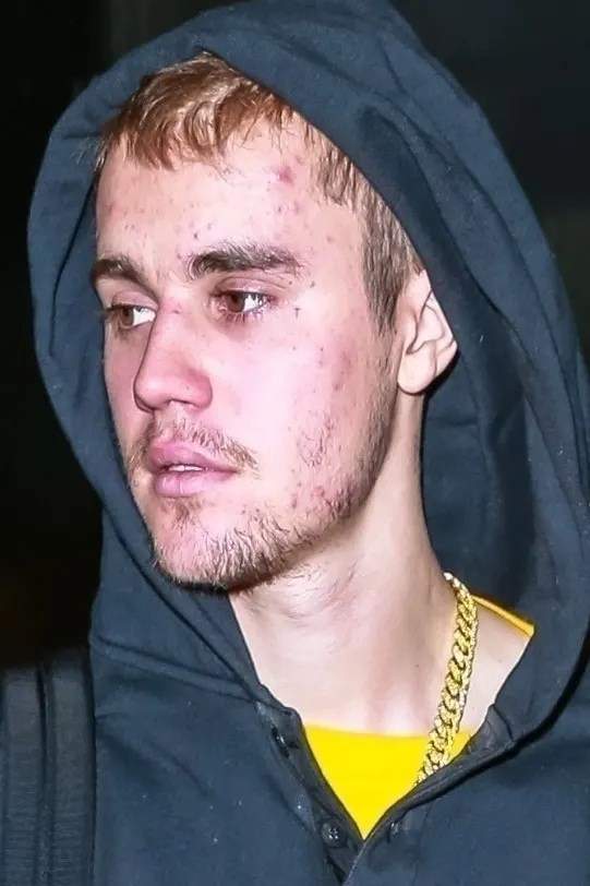 Justin Bieber spotted looking downcast with a severe case of acne (Photo)