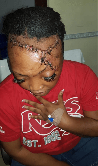 Woman who survived ghastly accident which split her head open shows off impressive transformation