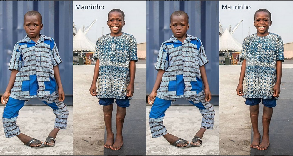 Young Boy 'Maurinho' All Smiles After Undergoing Successful Surgery To Correct His Bow Legs