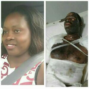 Malawian Cheating Wife Burns Hubby With Petrol After He Caught Her Cheating (Pics)